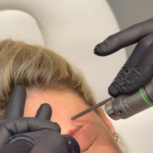 Eye-Brow-Tattoo-removal