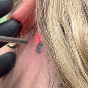 Tattoo-Removal-Chania-Crete-Greece