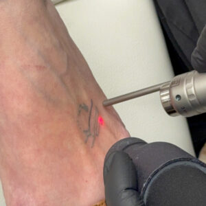 Αφαίρεση-Τατουάζ-