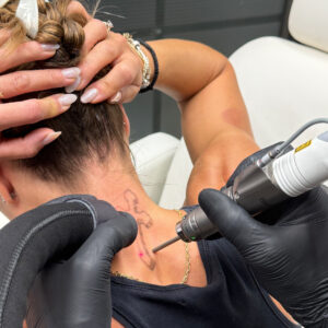 Αφαίρεση-Τατουάζ-Κρήτη