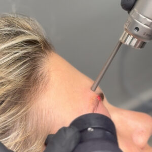 Αφαίρεση-τατουάζ-φρυδιών