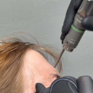 Αφαίρεση-τατουάζ-φρύδια